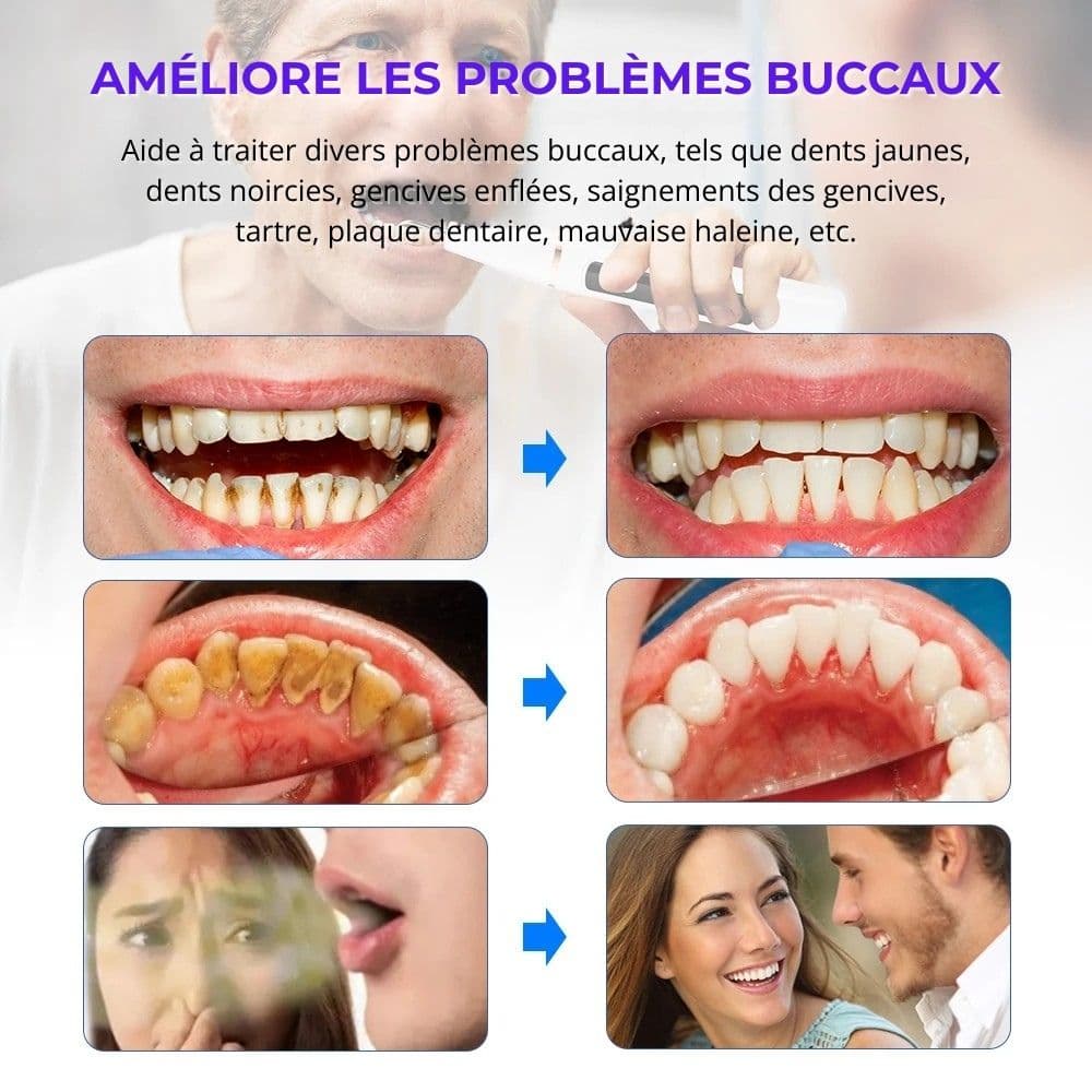 Détartreur dentaire à ultrasons USB – nettoyage des dents à domicile