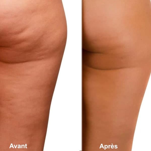 Appareil de massage anti-cellulite moderne à ventouse