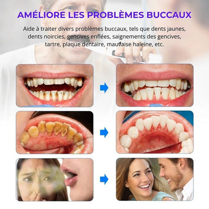 Détartreur dentaire à ultrasons USB – nettoyage des dents à domicile