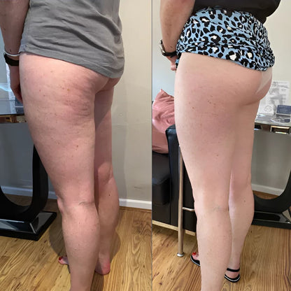 Appareil de massage anti-cellulite corporel