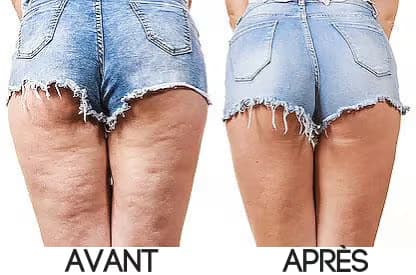 Brosse de massage anti-cellulite rotative à vibrations